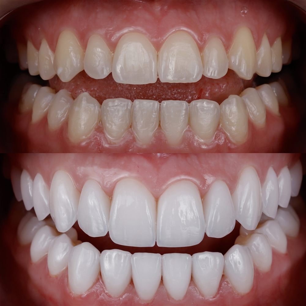 Antes e depois - caso 2